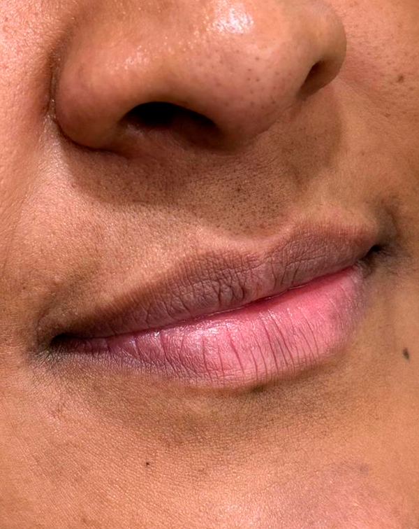 botox 10 antes