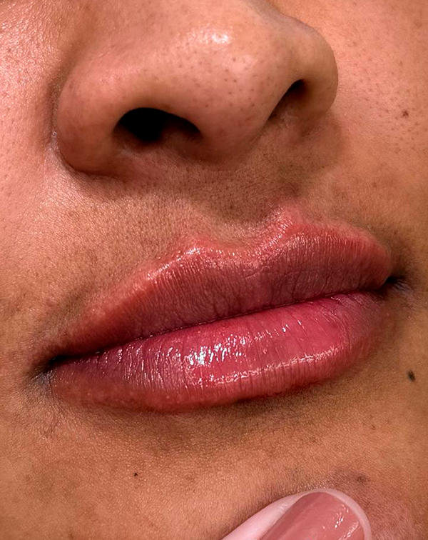 botox 10 depois