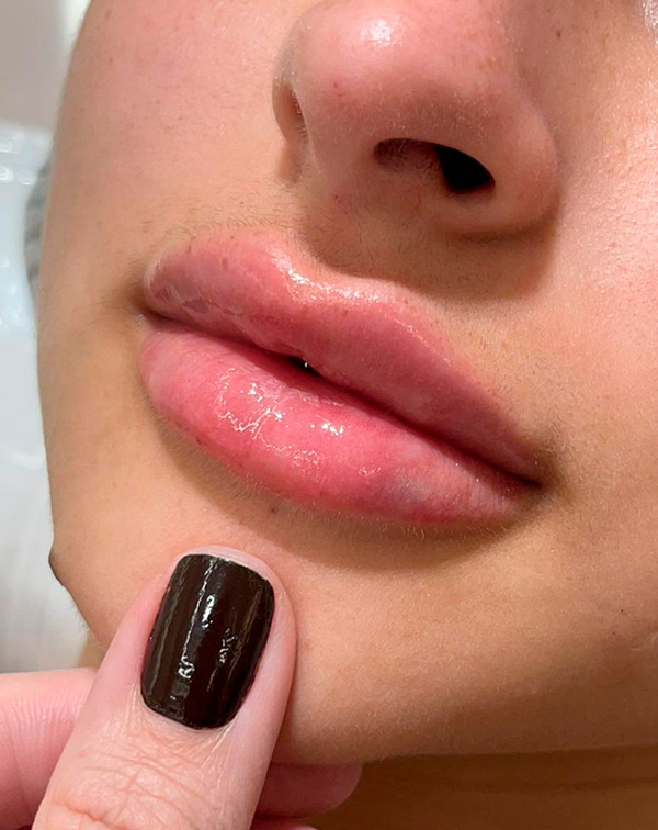 botox 2 antes