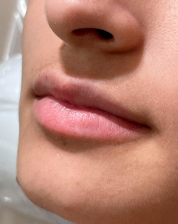 botox 2 depois
