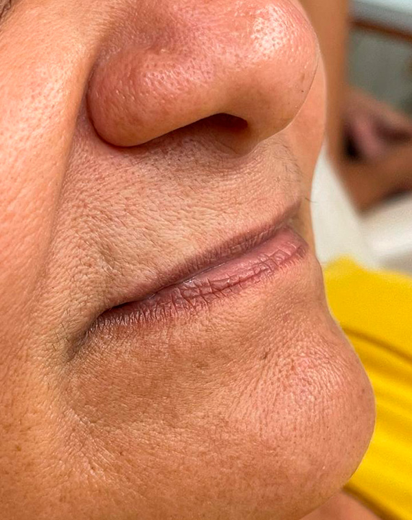 botox 6 antes
