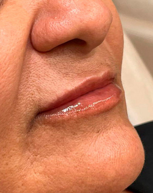 botox 6 depois
