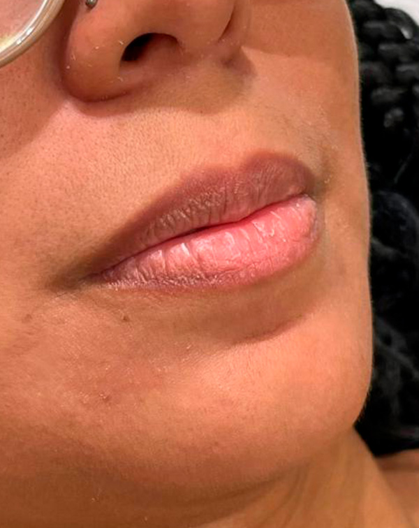 botox 7 antes