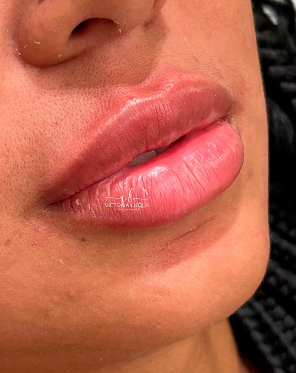 botox 7 depois