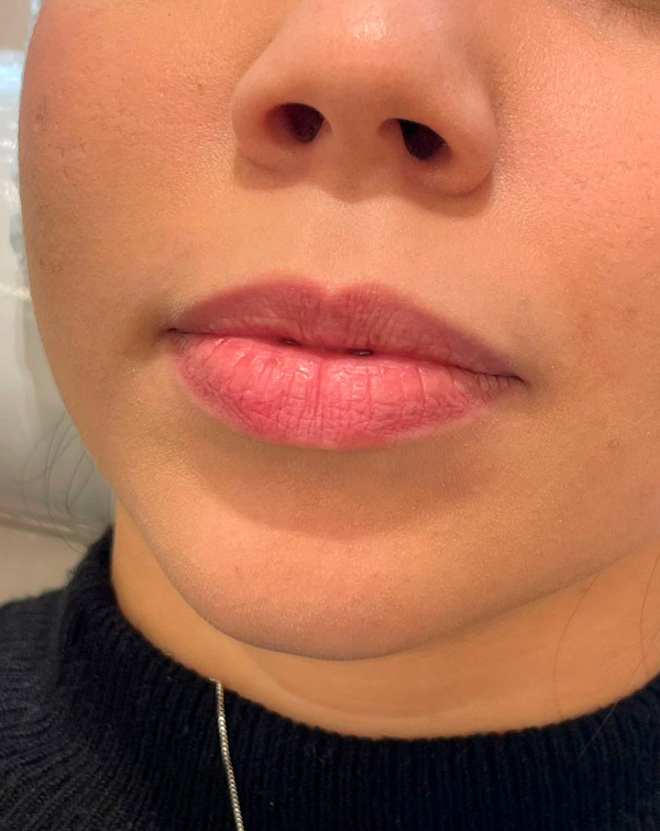 botox 8 antes