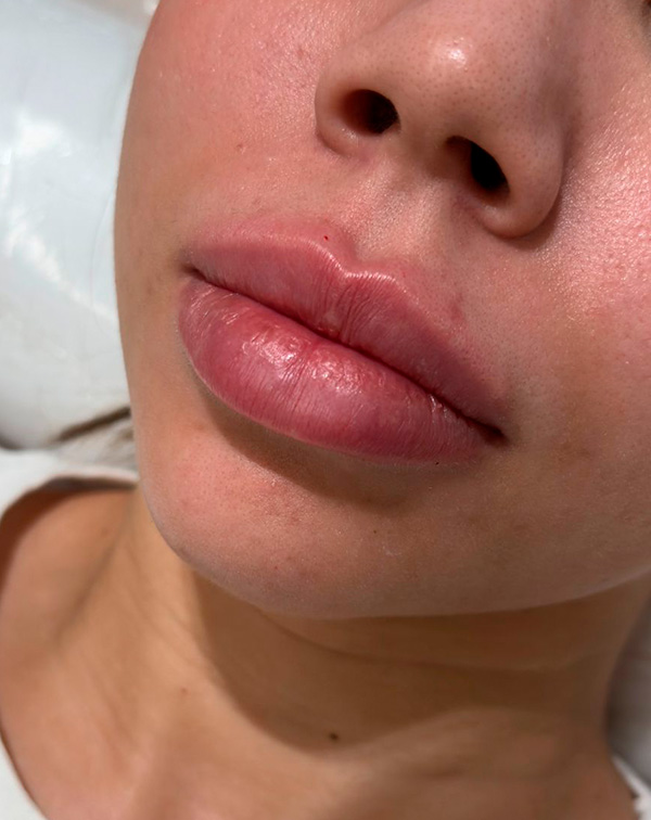botox 8 depois