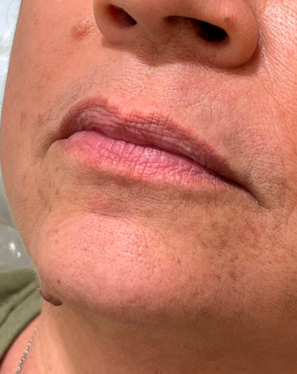botox 9 antes
