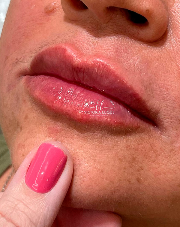 botox 9 depois